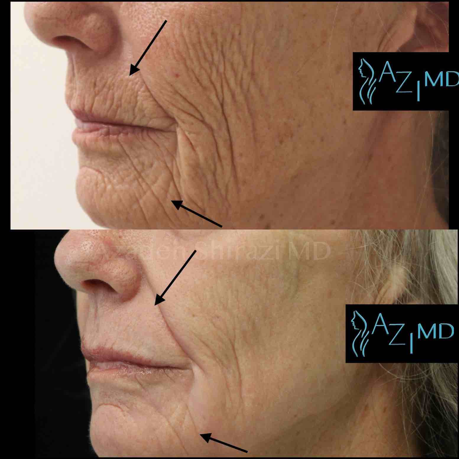 Woman Before & After Face Contouring Fillers
