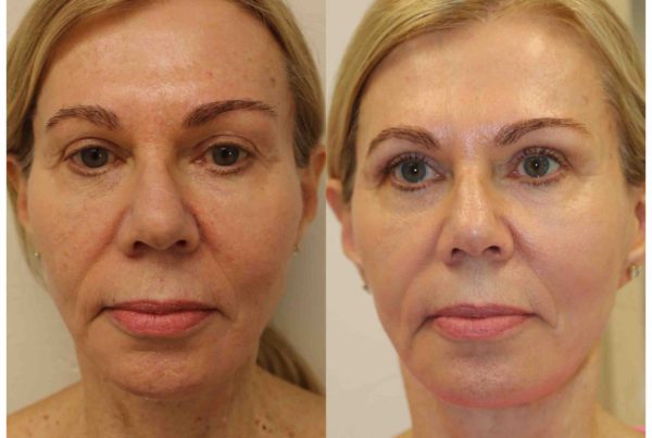 Older Woman Before & After Receiving Treatment For Sun Damaged Skin