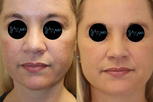 Woman Before & After Sun Damaged Skin Treatment