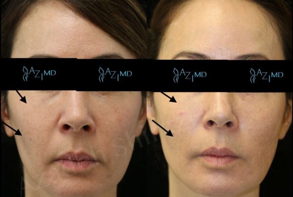 Before & After Facial Rejuvenation