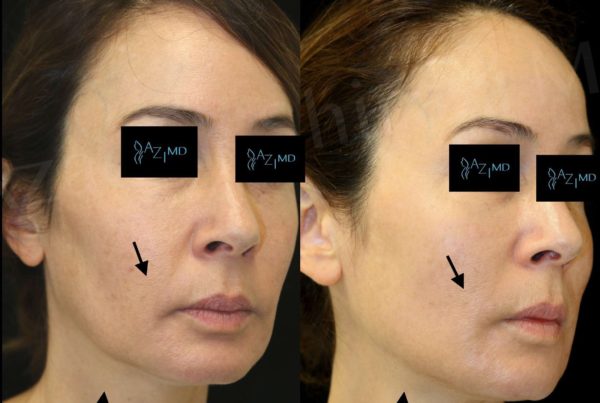 Woman Before & After Facial Rejuvenation Treatment