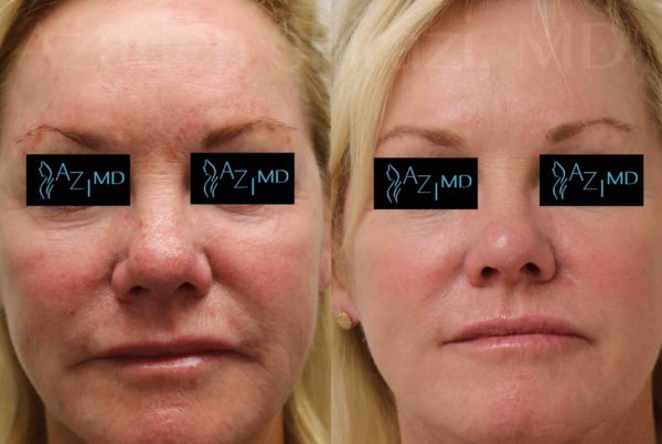 Woman's Before & After Halo Laser Treatment