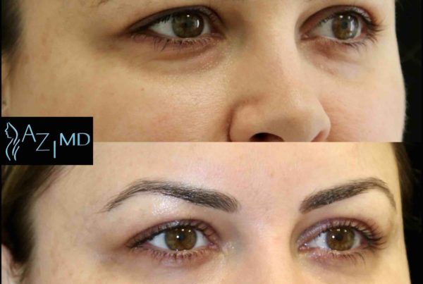 Before & After Under Eye Rejuvenation