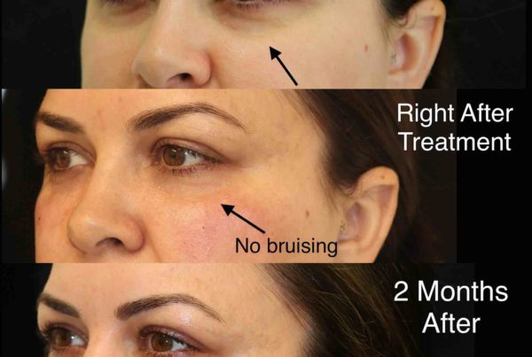 3 Pictures Of Woman Before & After Under Eye Rejuvenation