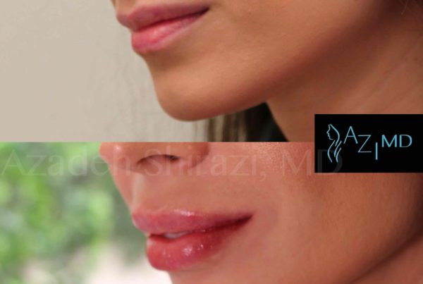 Woman Before & After Lip Rejuvenation