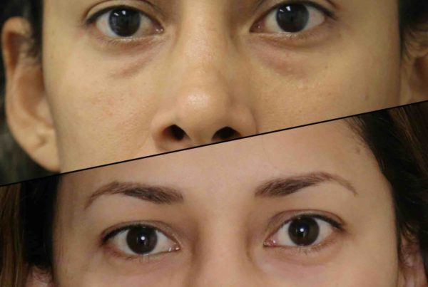 Close Up Of Woman Before & After Under Eye Rejuvenation