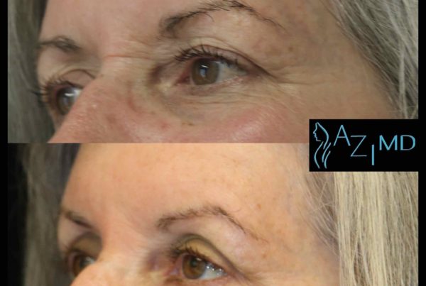 Woman Before & After Botox Under Eyes Treatment