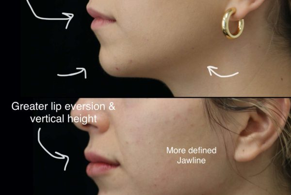 Profile Of Woman Before & After Mini Face Lift Procedure