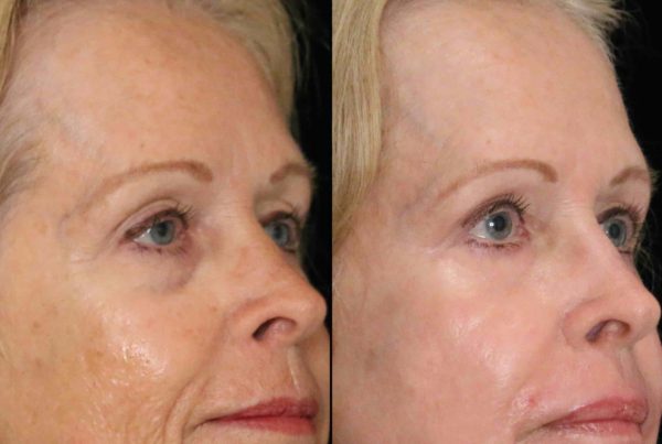 Woman Before & After Non Surgical Face Contouring