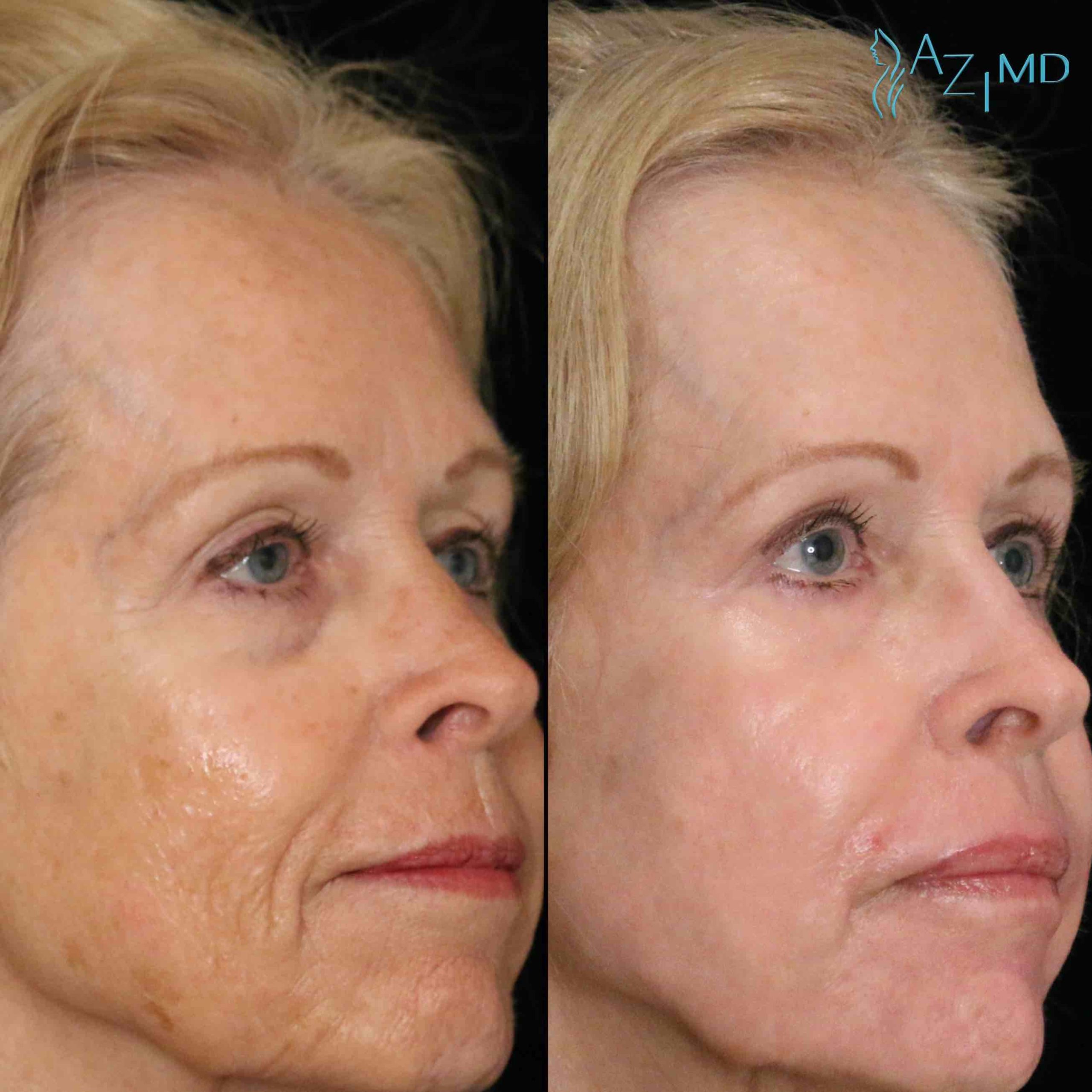 Woman Before & After Non Surgical Face Contouring