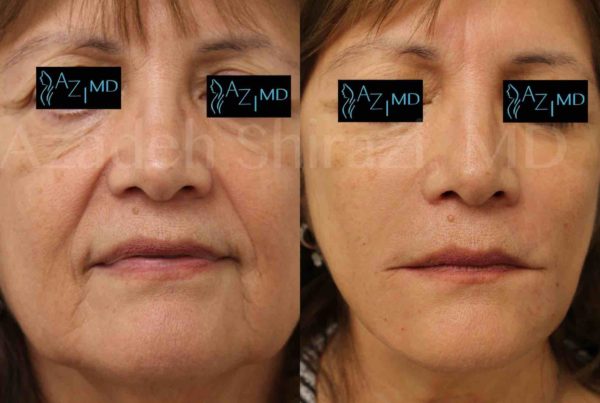 Woman Before & After Mini Face Lift Procedure
