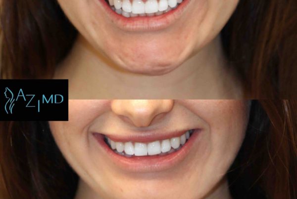 Woman Before Botox Lip Treatment
