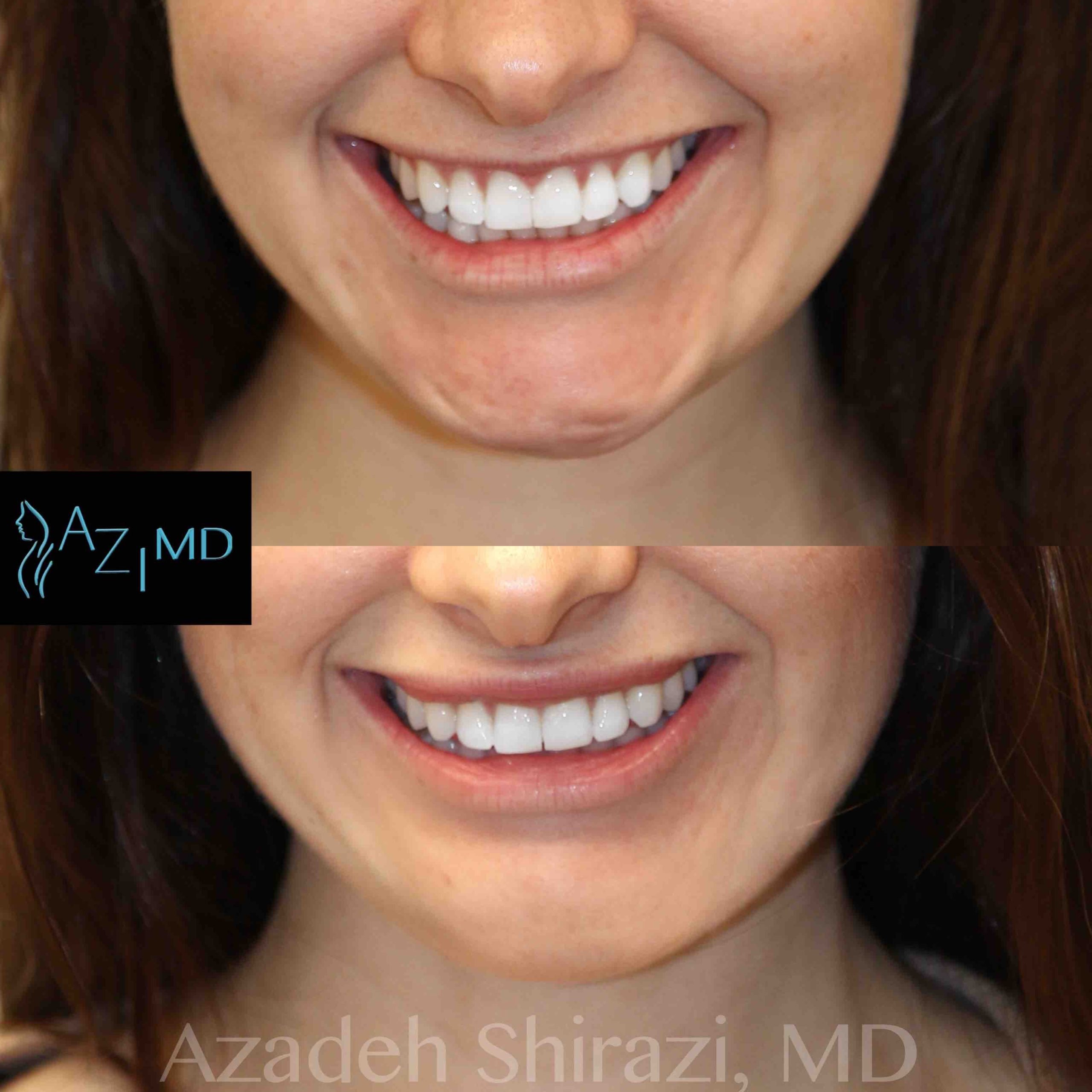 Woman Before Botox Lip Treatment