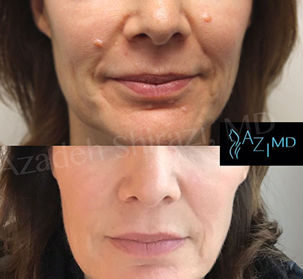Woman Before & After Laser Mole Removal