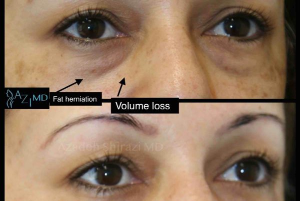 Woman Before & After Under Eye Rejuvenation
