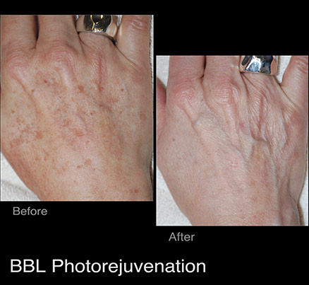 Ladies Before & After Hand Rejuvenation
