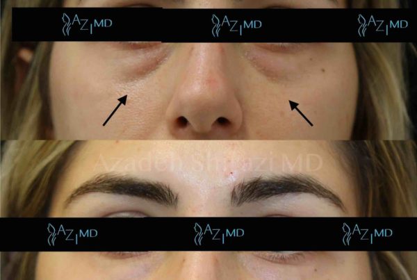 Before & After Under Eye Treatment