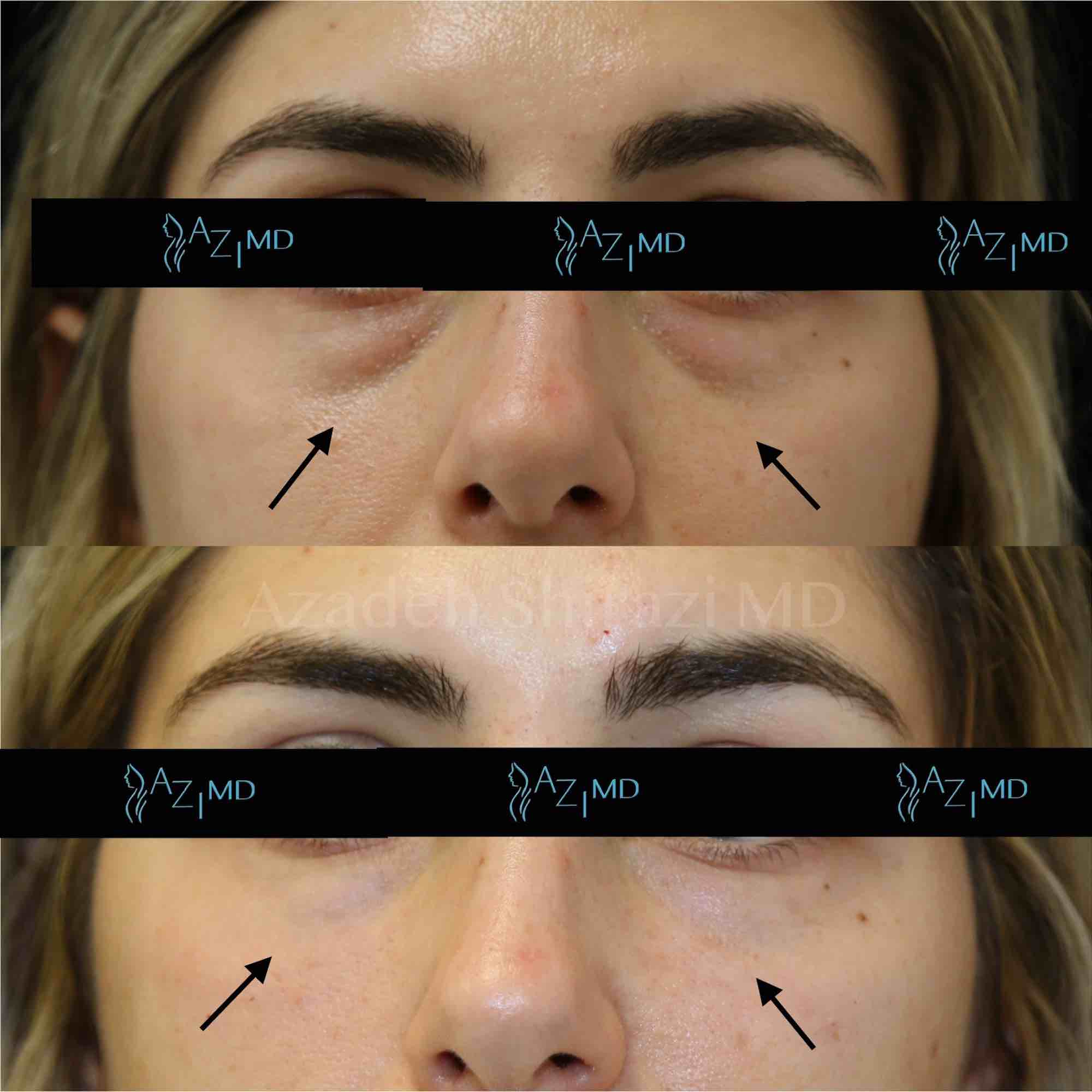 Before & After Under Eye Treatment