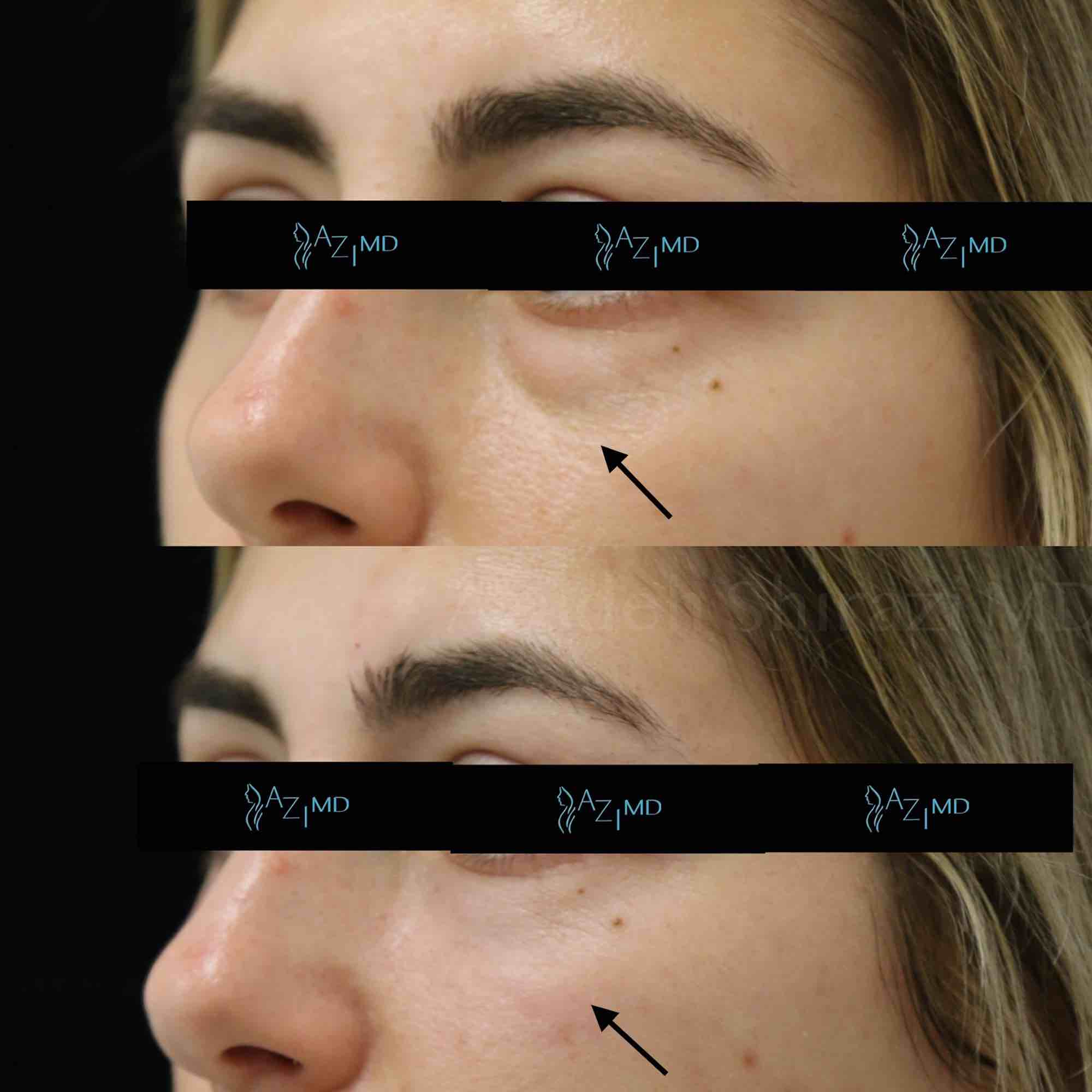 Results Of Under Eye Rejuvenation