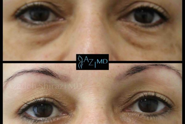 Woman's Eyes Before & After Eye Rejuvenation