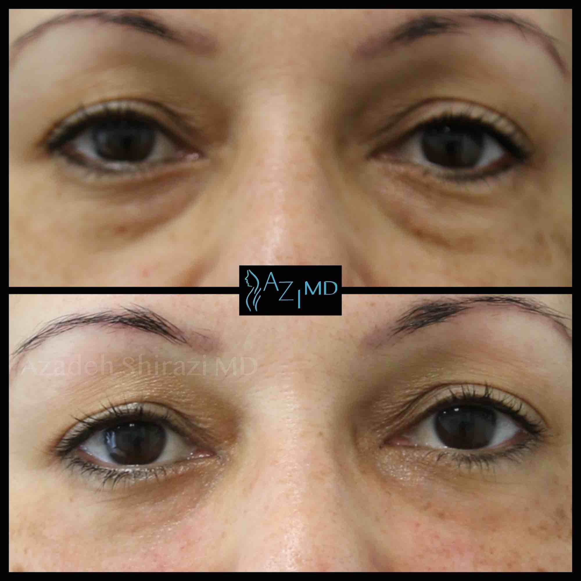 Woman's Eyes Before & After Eye Rejuvenation