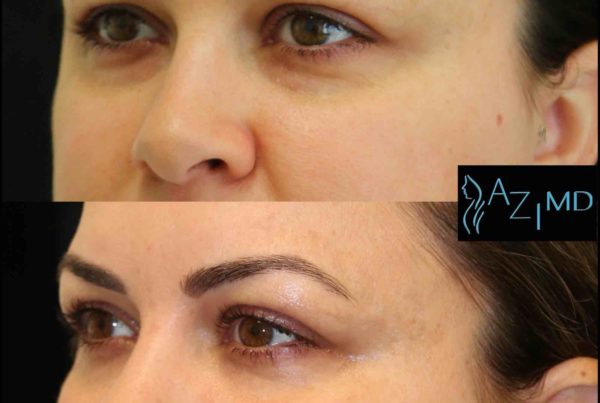 Close Up Of Woman's Eyes Before & After Under Eye Rejuvenation