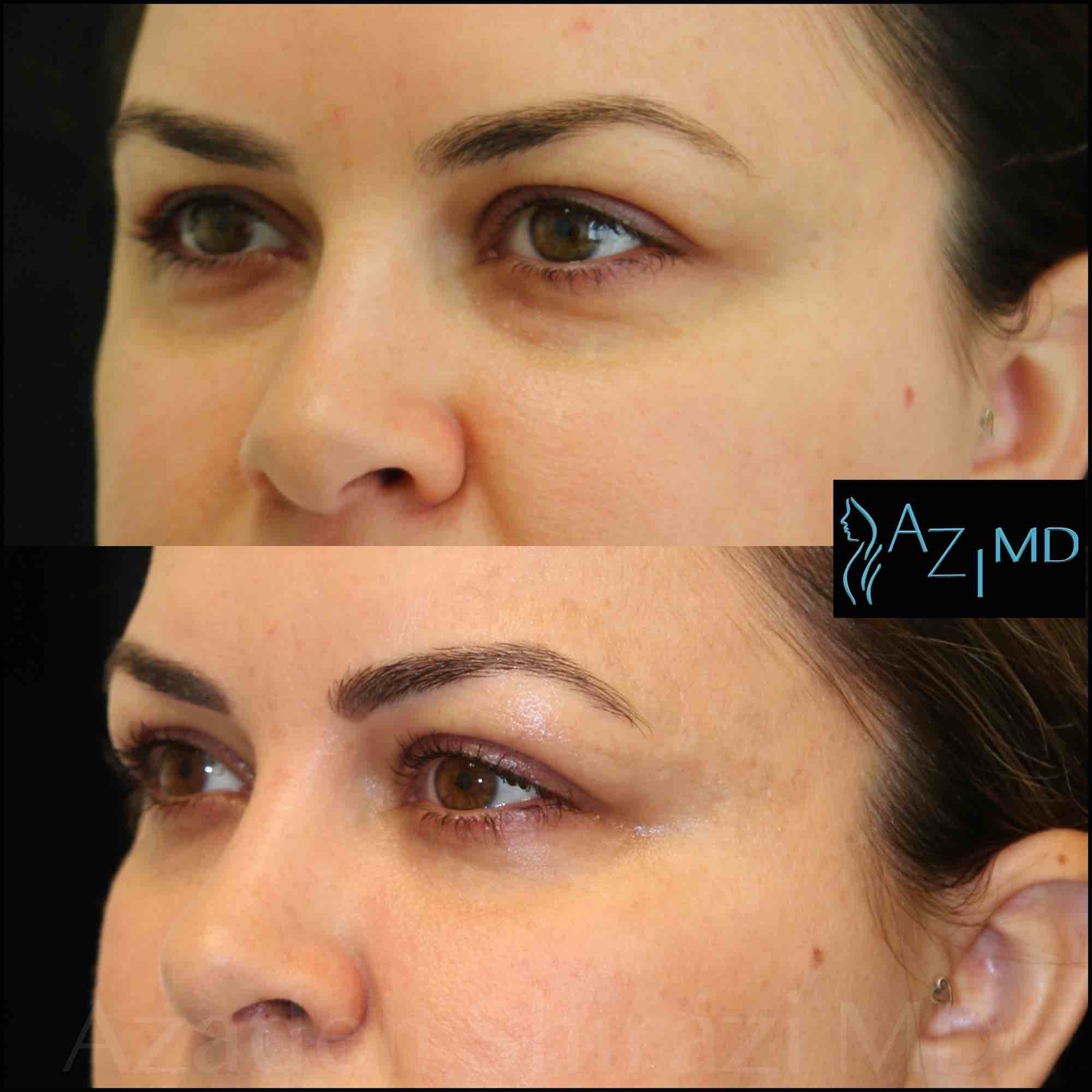 Close Up Of Woman's Eyes Before & After Under Eye Rejuvenation