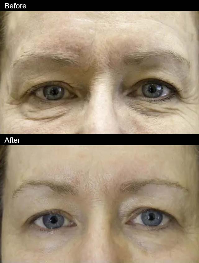 patient before and after Exilis Ultra in La Jolla