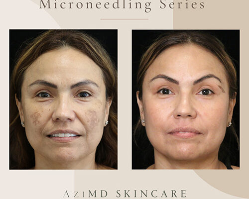 microneedling-2