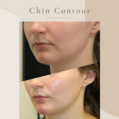 Chin-Contour-1