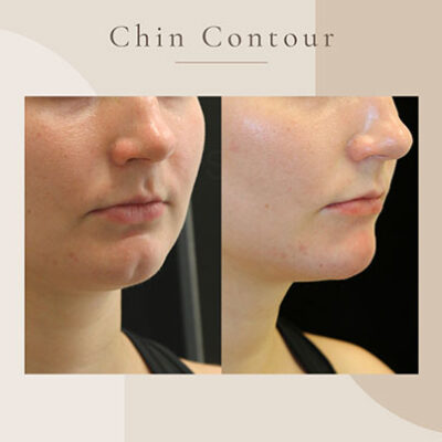 Chin-Contour-2