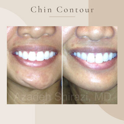 Chin-Contour-3