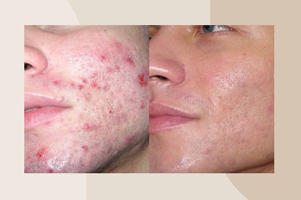 Before and after photo, with acne skin now resolved with DiamondGlow in La Jolla.