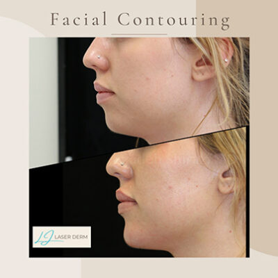 facial-balancing-3 facial-balancing-3