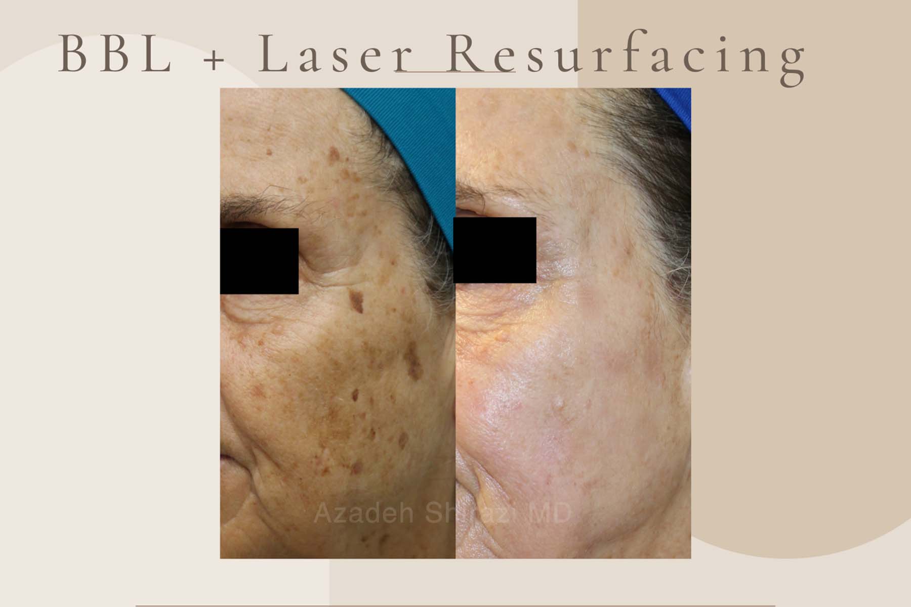 Before and after photos showing much less sun damage after laser rejuvenation in La Jolla.