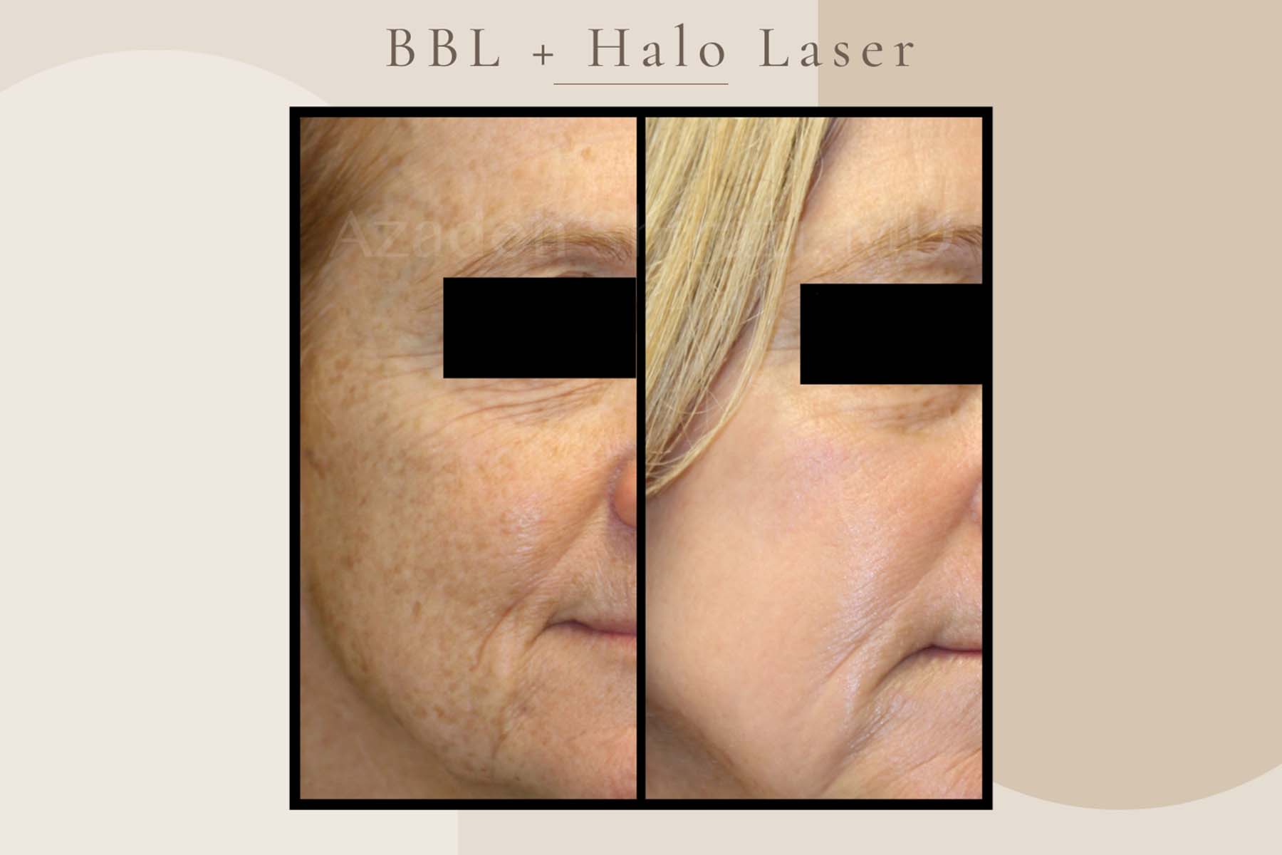 Before and after photos of a woman with less spots after laser rejuvenation in La Jolla.