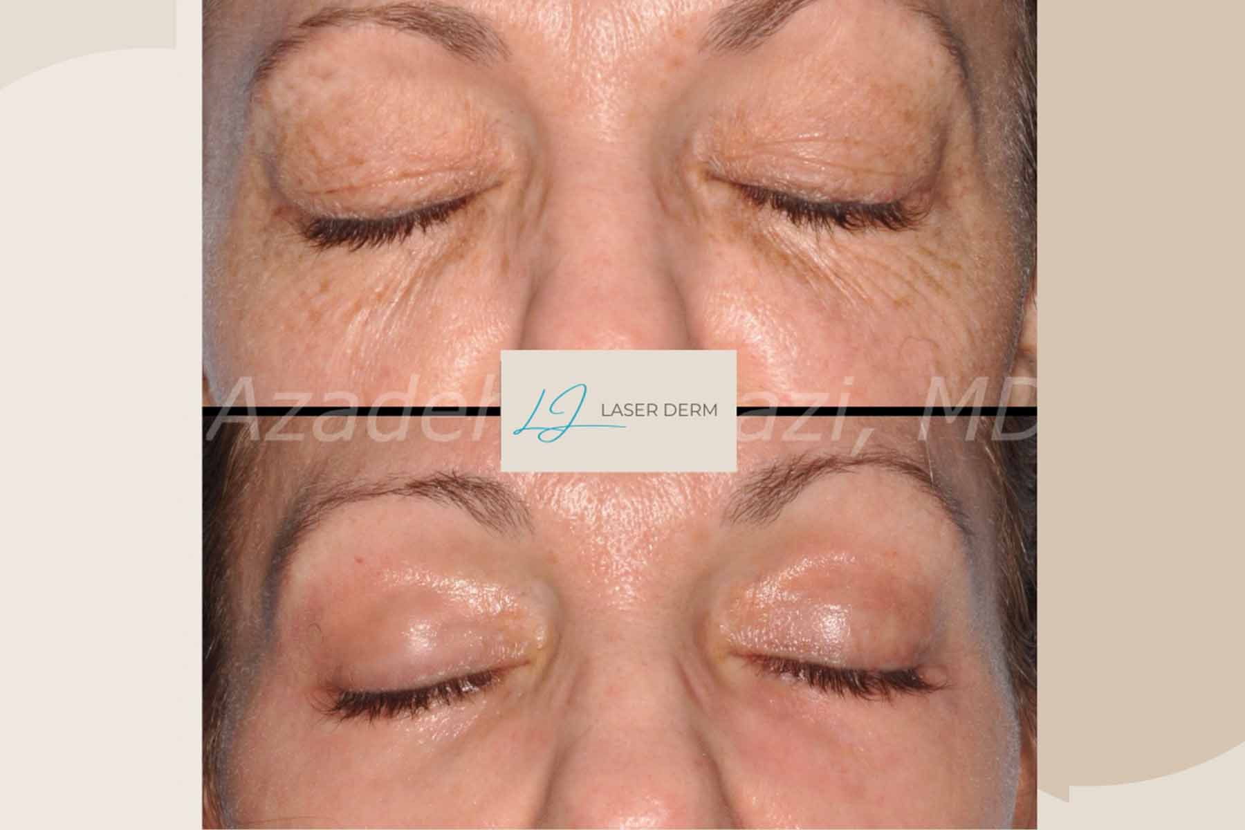 Before and after photos showing less wrinkles after laser rejuvenation in La Jolla.