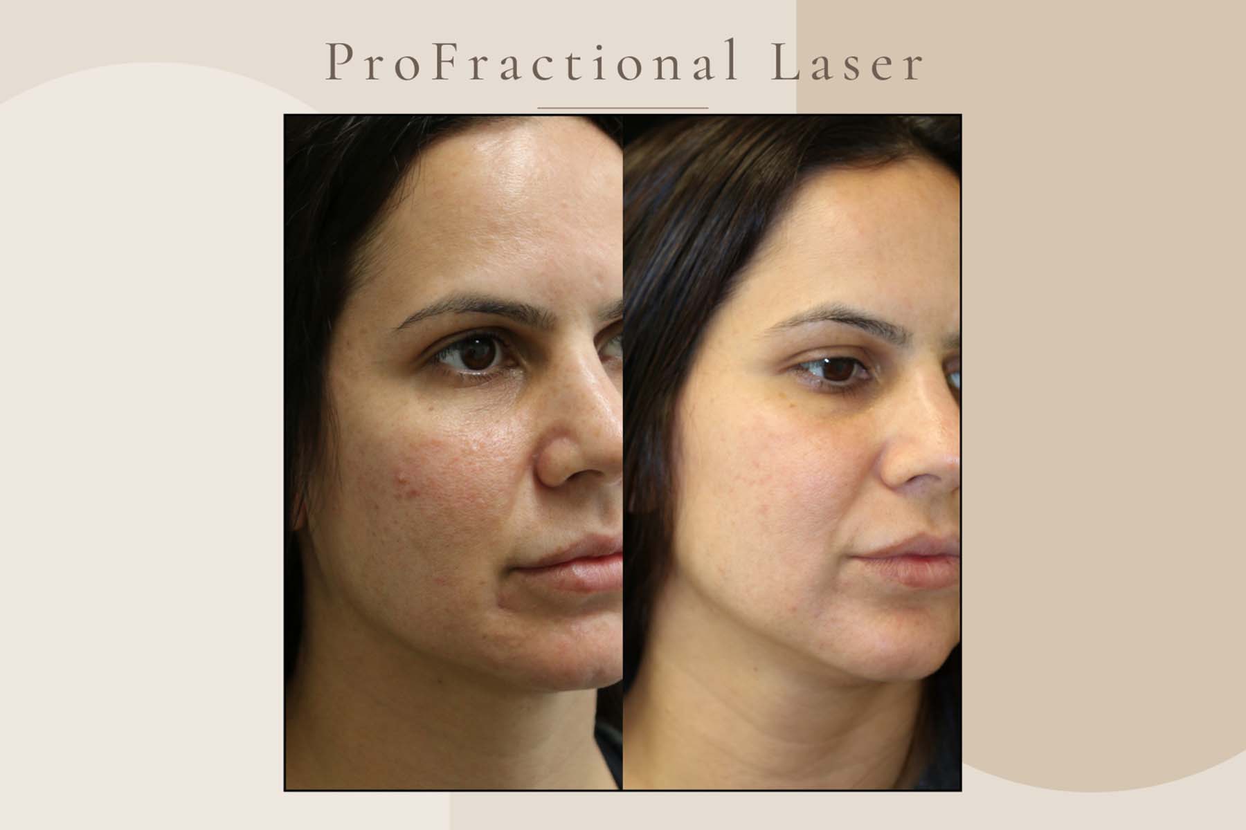 Before and after photos showing better skin texture after laser rejuvenation in La Jolla.