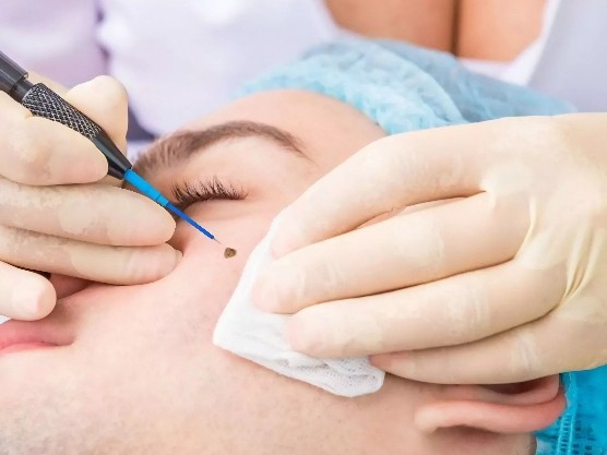 Mole & Skin Tag Removal in San Diego: What to Expect