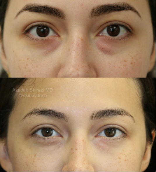 Agnes RF before and after under-eye results by Dr. Azadeh Shirazi
