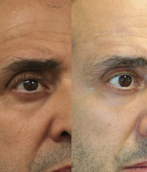 Agnes RF before and after, male under-eye area