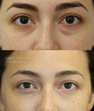 Agnes RF before and after, female under-eye bags
