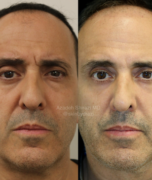 Agnes RF before and after, male lower eyelids