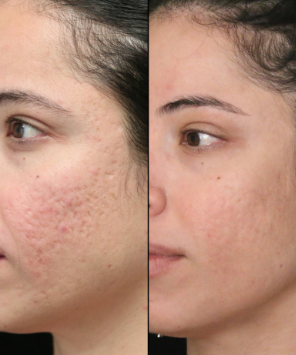 Before and after treatment for acne scarring at La Jolla Laser Derm