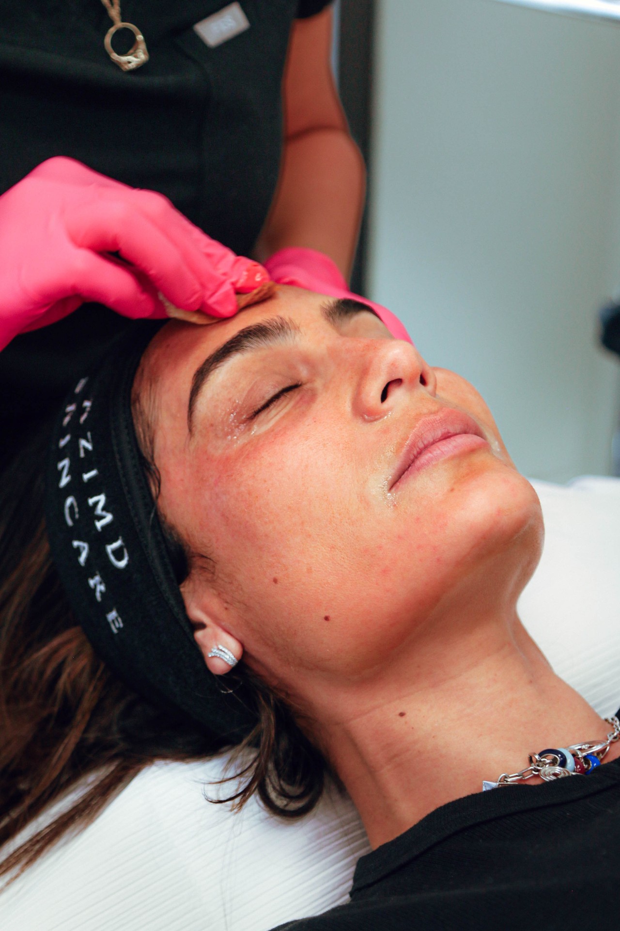 Chemical Peels treatment at La Jolla Laser Derm