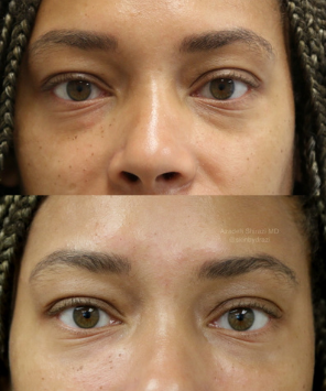 Before and after EyeGlow treatment for under-eye circles at La Jolla Laser Derm