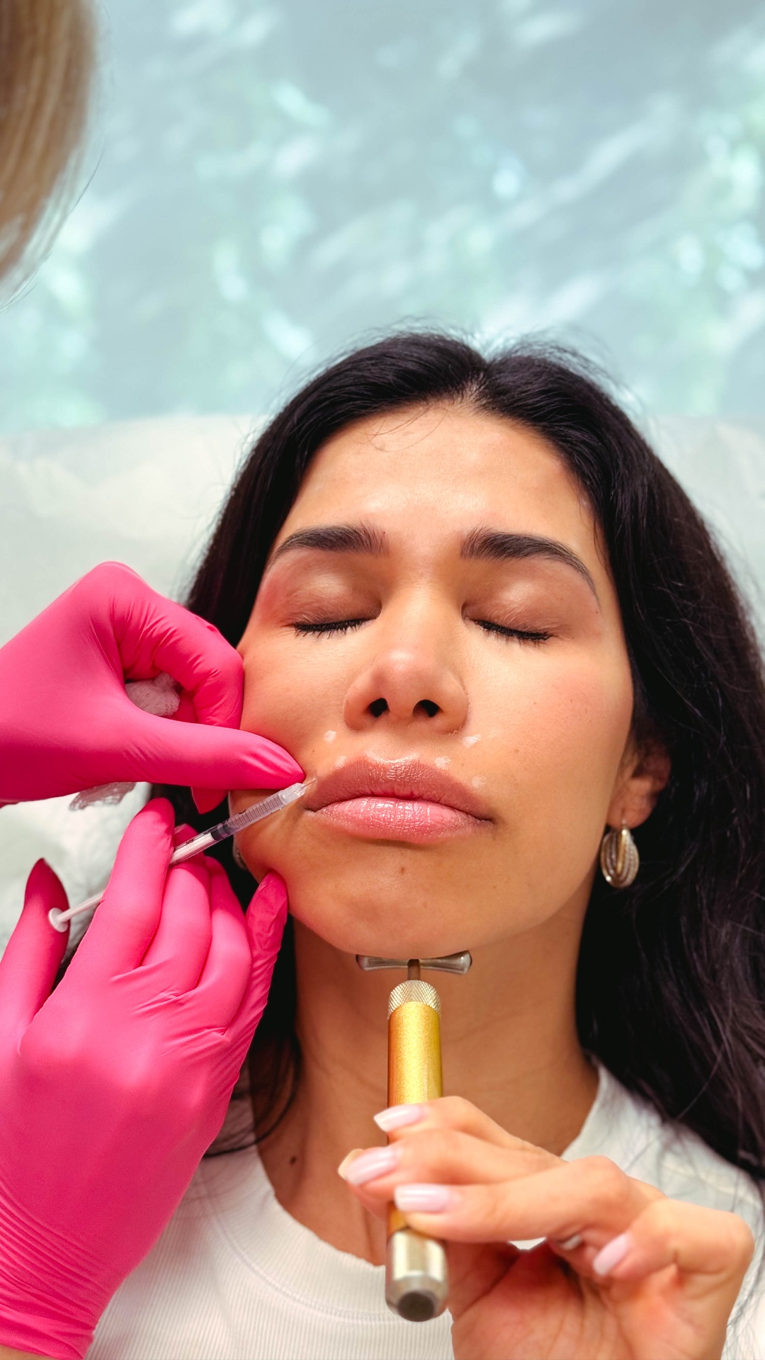 Patient with eyes closed receiving a lower-face filler injection at La Jolla Laser Derm
