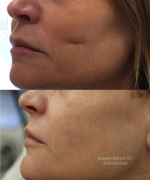 Before and after midface contouring and volume restoration at La Jolla Laser Derm